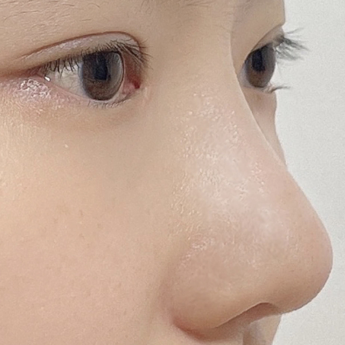 Би 4-р сард Волхэ-д нүд, хамар засварлуулснаас хойш 2 сар болж байна. хехе