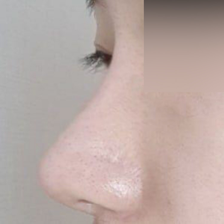 Хамрын харшлын мэс засал болон хамрын гоо сайхны мэс заслыг хамт хийлгэсэн!