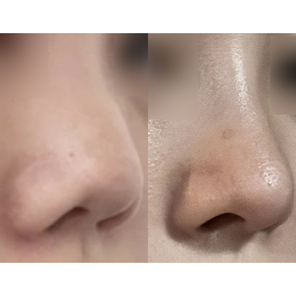 Хамрын мэс засал хийлгэснээс хойш сар гаруй боллоо!