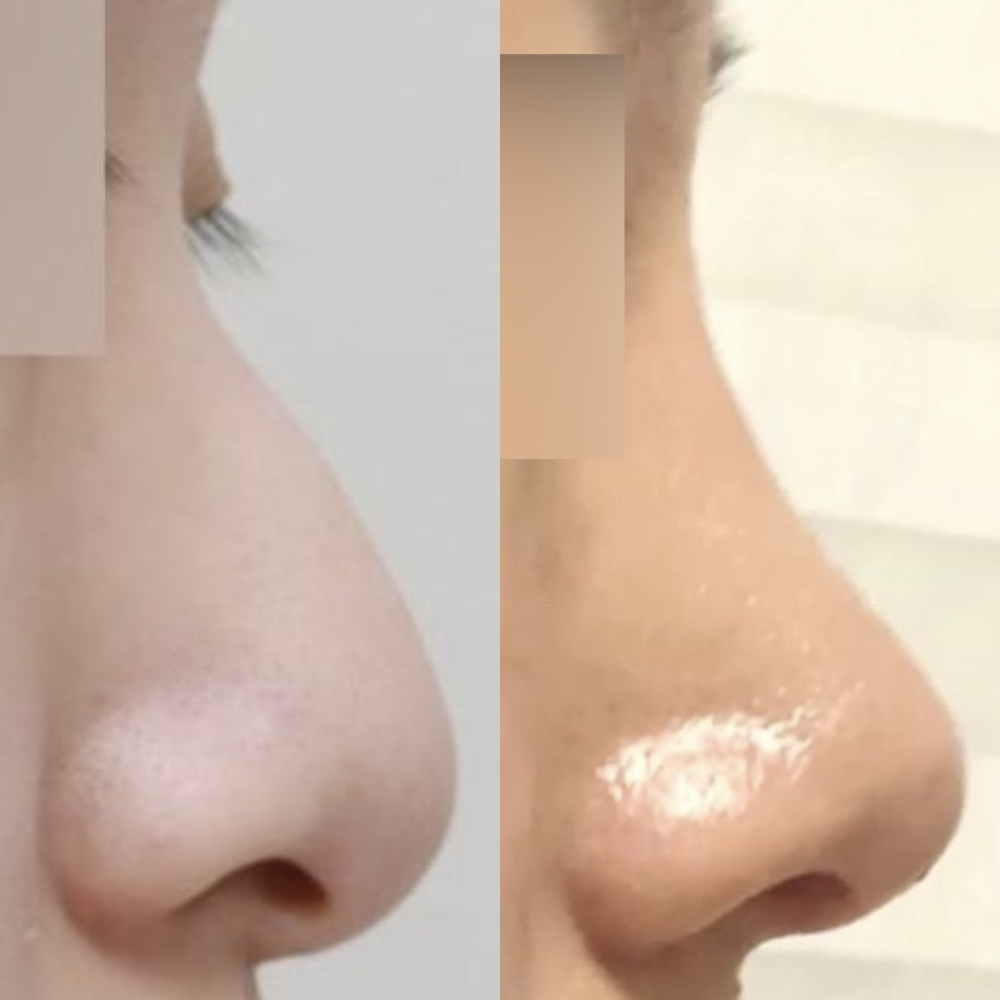 Би хамрын анхны мэс ажилбараа имплантгүйгээр хийлгэсэн!