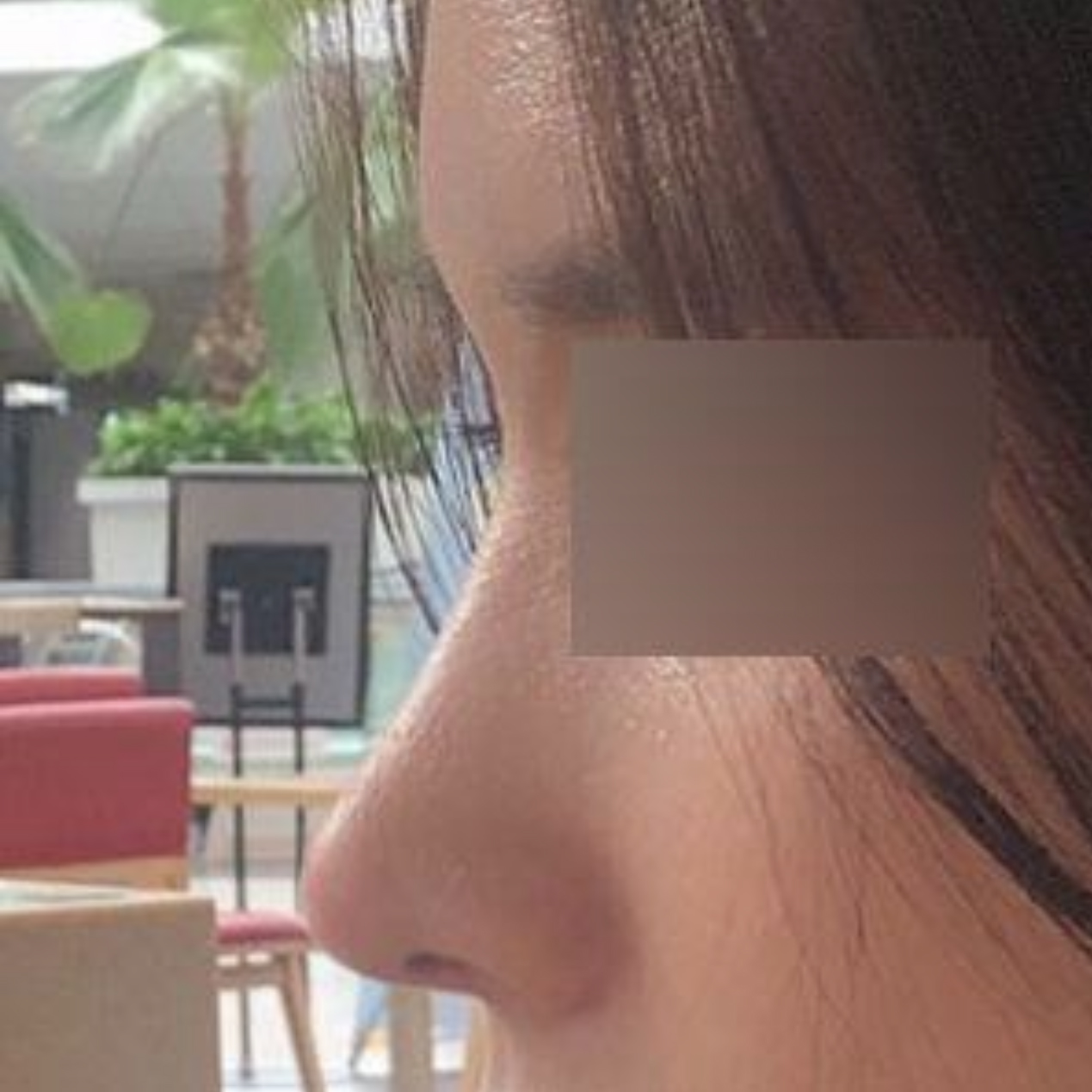 Нарийхан байсан бөгтгөр хамар засварлуулсан