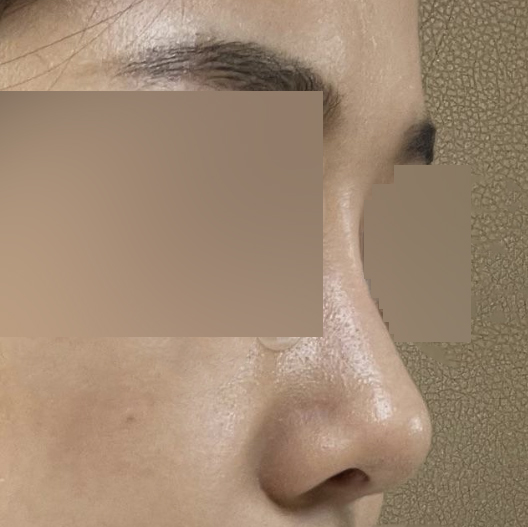 Мэс засал хийлгэснээс хойш 3 сар гаруйн дараах сэтгэгдэл байнаа~