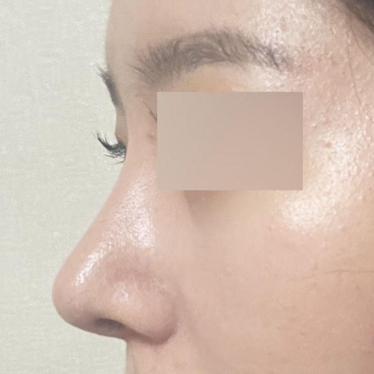 Битүү хамар засварын хагалгааны дараах 2 дахь долоо хоног