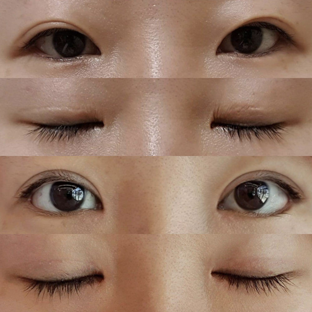 Нүдний хагалгаанд ороод 2 сар болж байна