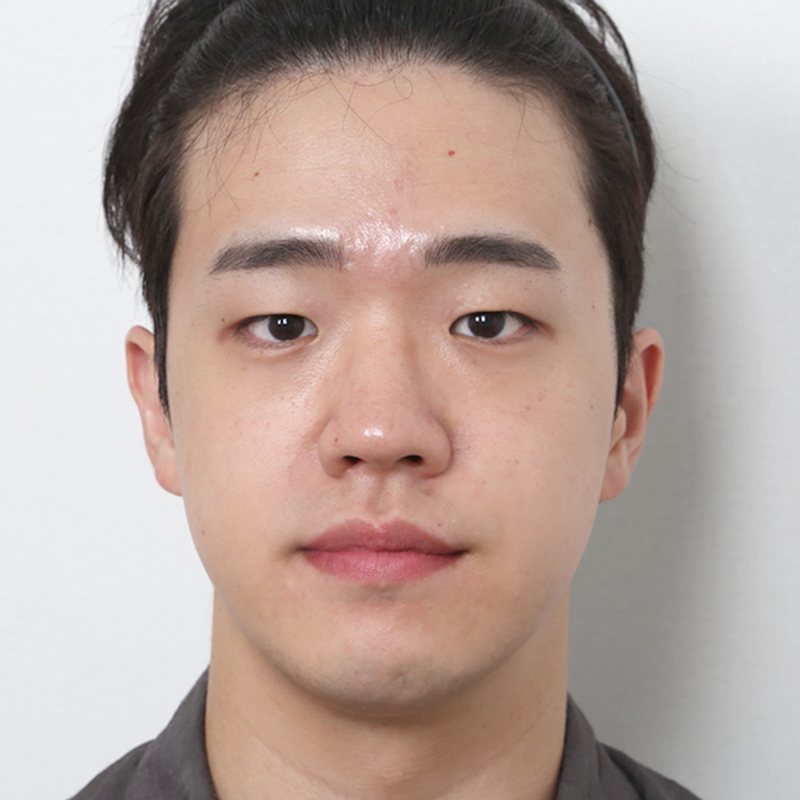 #Хэсэгчилж зүсэлт #Нүдний хэлбэр засах #Хамрын нуруу (силикон) #Хамрын үзүүр (өөрийн мөгөөрс)