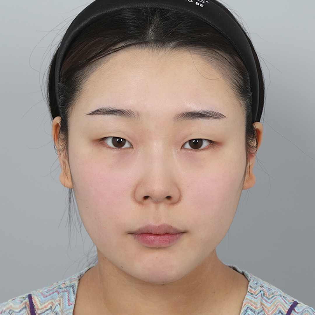 #Хэсэгчилсэн зүслэг #Дээд зовхины нүх гаргах #Дээд зовхины өөх авах #Хамрын нуруу (силикон) #Хамрын үзүүр (өөрийн мөгөөрс)