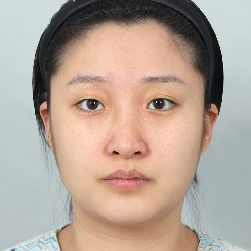 #Хэсэгчилсэн зүслэг #Хамрын үзүүр (өөрийн мөгөөрс) #Имплантгүй хамар заслын хагалгаа #Бөхтэй хамрын залруулга сумтай хамрын залруулга