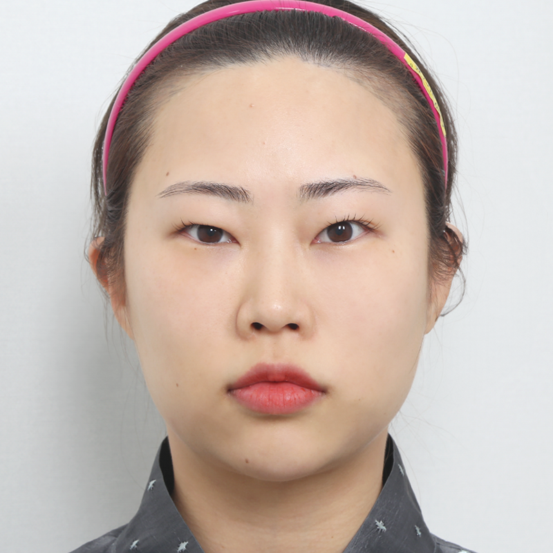 #Хэсэгчилсэн зүсэлт #Дээд зовхины өргөлт #Ар, доод зовхины өргөлт #Нүдний дээд өөх авах #Хамрын нуруу (силикон) #Өөрийн хавирганы мөгөөрсөөр хамар засах