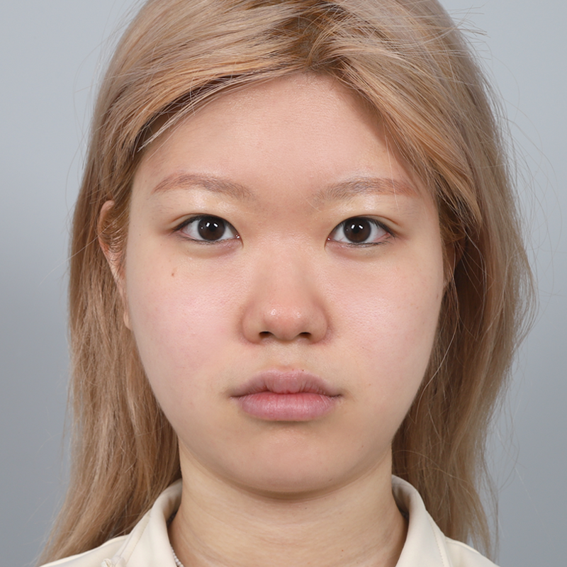 #Хамрын нуруу (силикон) #Хамрын үзүүр (өөрийн мөгөөрс) #Түмрэн хамар засах