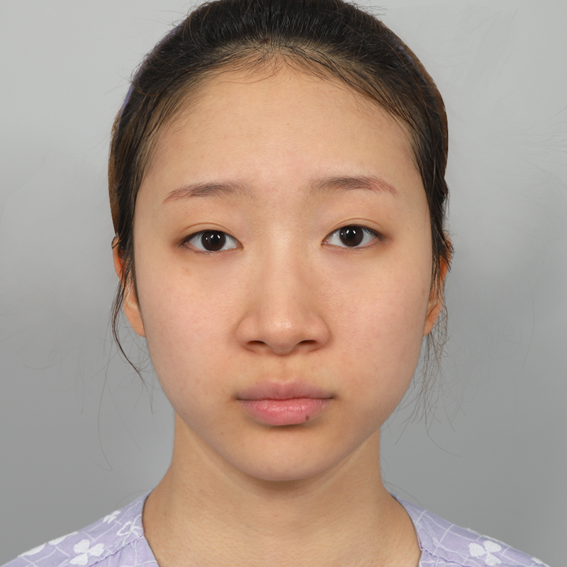 #Хамрын нуруу (силикон) #Хамрын үзүүр (өөрийн мөгөөрс) #Хамрын жижигсгэл