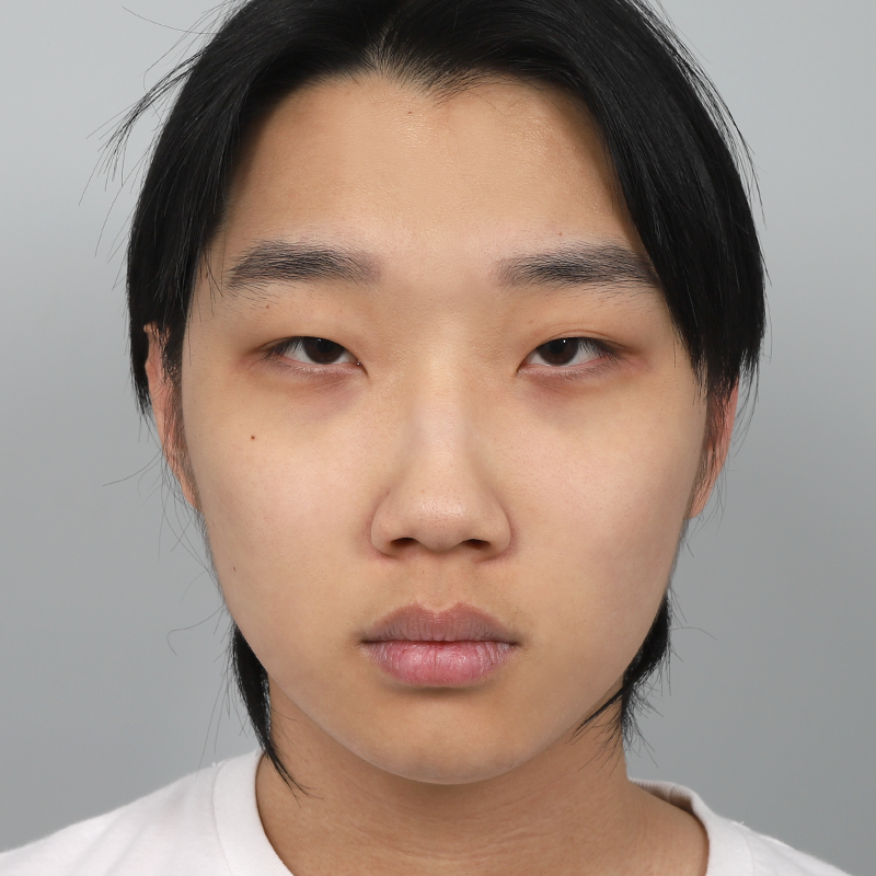 #Хэсэгчилсэн зүслэг #Нүдний хэлбэр засах #Хамрын нуруу (силикон) #Хамрын үзүүр (өөрийн мөгөөрс) #Хамрын нүх багасгах