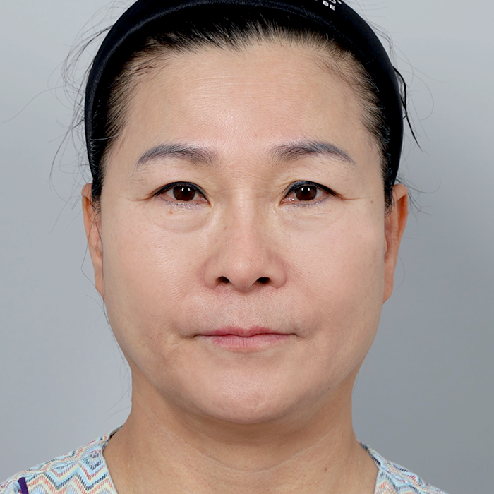 #Доод зовхи #Дух өргөх (эндотин) нүүр өргөх