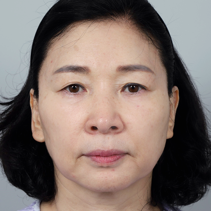 #Дээд зовхи #Доод зовхи хөмсөг өргөх нүүр өргөх