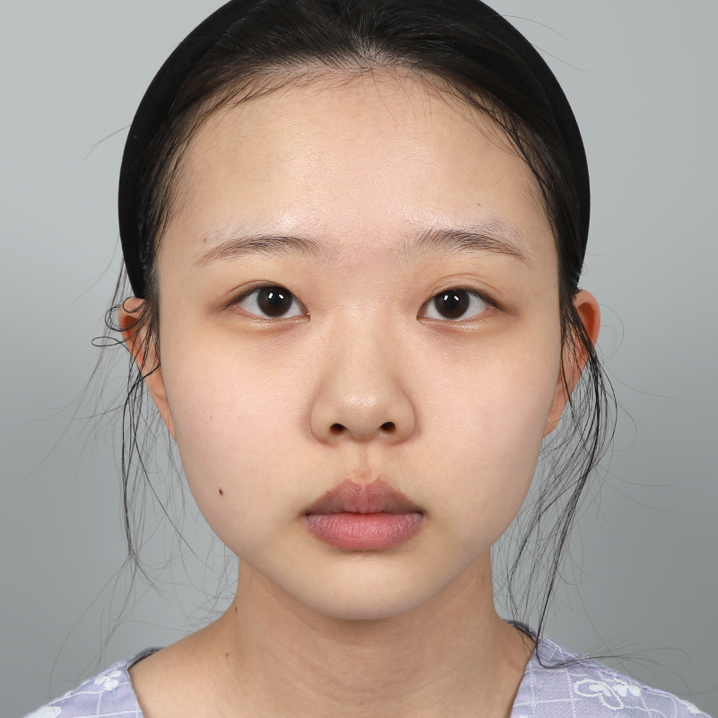 #Хэсгийн зүсэлт #Дээд зовхины өргөлт #Наалдсан эдийг салгах #Хамрын нуруу (силикон) #Хамрын үзүүр (өөрийн мөгөөрс) Нүдний дахин хагалгаа