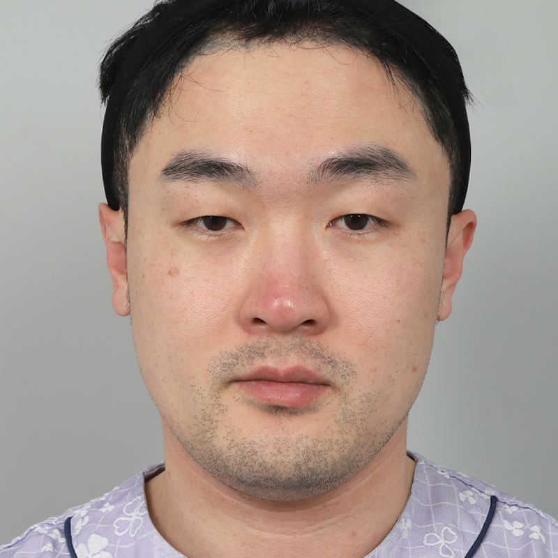 #Хэсэгчилсэн зүслэг #Нүдний хэлбэр засах #Хамрын нуруу (силикон) #Хамрын үзүүр (өөрийн мөгөөрс)