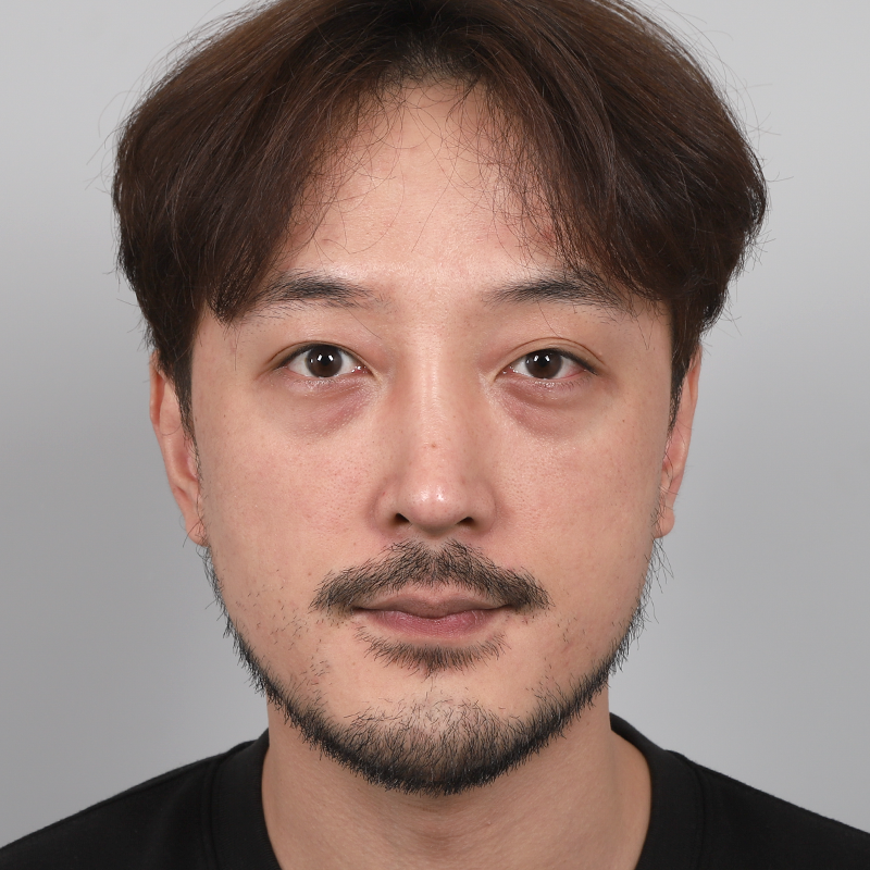 #Хэсэгчилсэн зүсэлт #Нүдний доод өөх тосны дахин байршуулалт