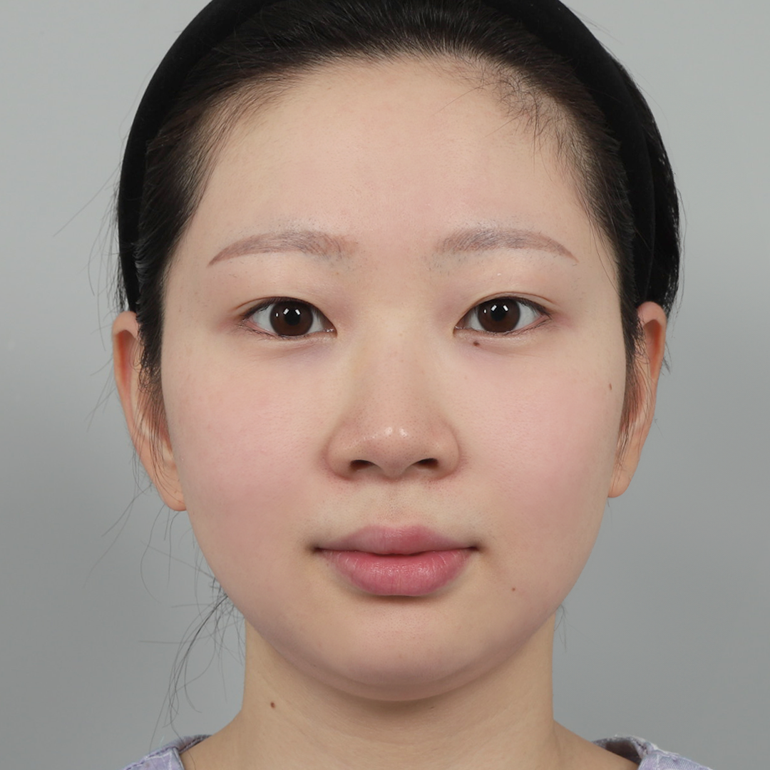 #Хамрын нуруу (силикон) #Хамрын үзүүр (өөрийн мөгөөрс)