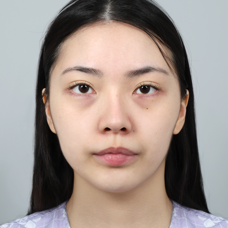 #Нүдний доорх өөх тосны байрлалыг сэргээх #Нүүрний өөх тосны шилжүүлэн суулгах бүх нүүрний өөх тосны шилжүүлэн суулгах