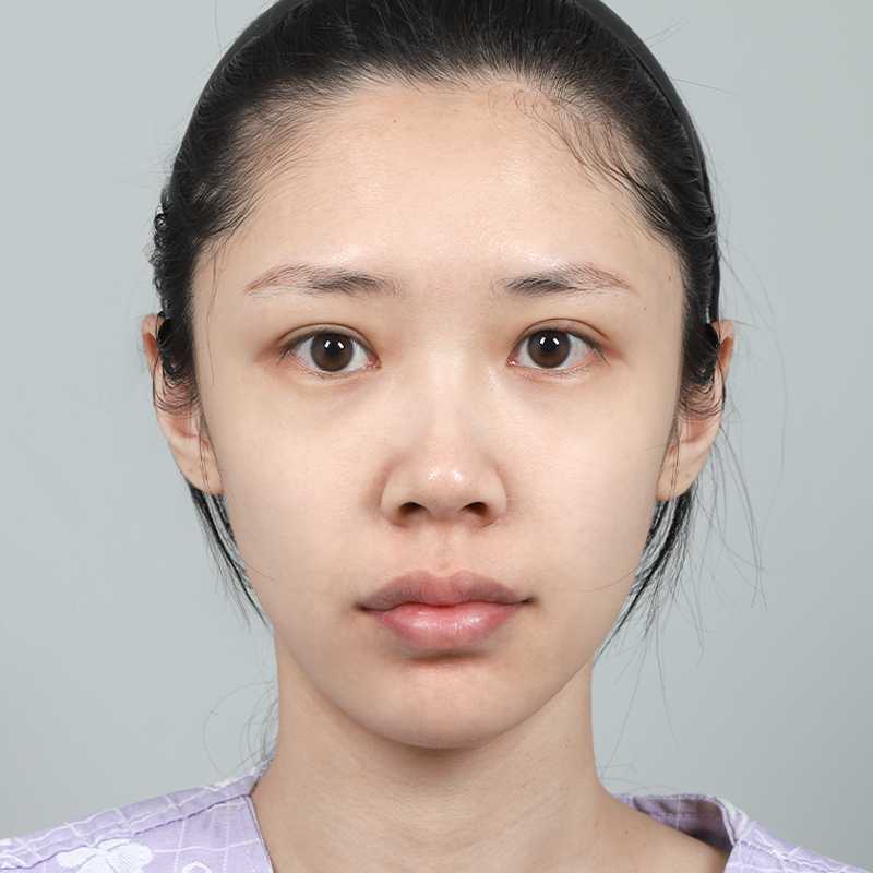 #Хамрын нуруу (силикон) #Хамрын үзүүр (өөрийн мөгөөрс)