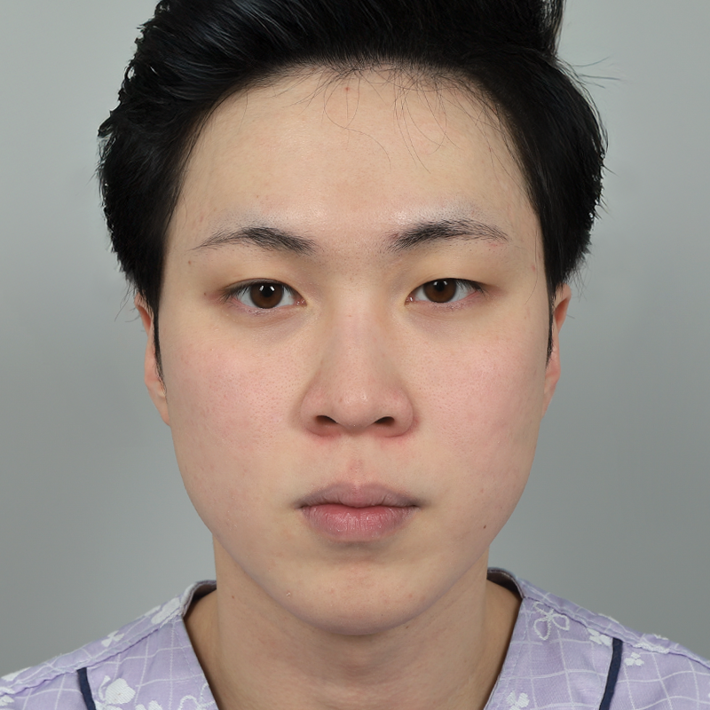 #Хэсэгчилсэн зүсэлт #Нүдний хэлбэр засах #Хамрын нуруу (силикон) #Хамрын үзүүр (өөрийн мөгөөрс)