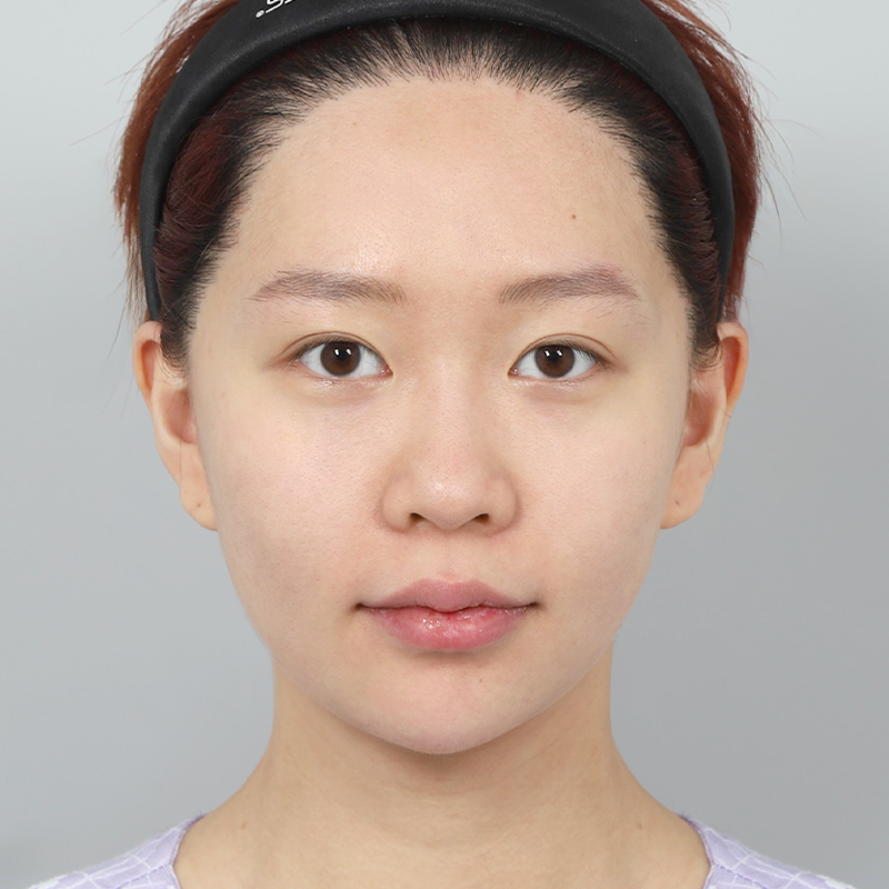 #Хамрын нуруу (силикон) #Хамрын үзүүр (өөрийн мөгөөрс) #Бух хамрын залруулга