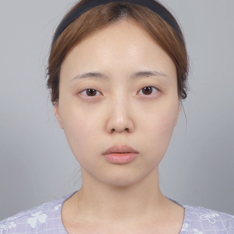 #Хэсэгчилсэн зүсэлт #Дээд зовхины нээлт #Дээд зовхины өөх шилжүүлэн суулгах #Нүдний хэлбэр засах