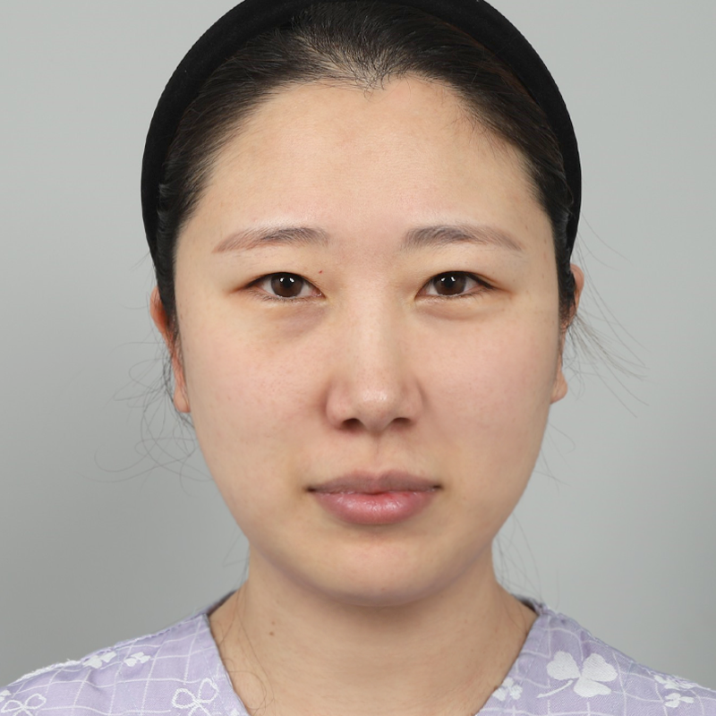 #Бүрэн зүслэг #Ар, доод зовхины өргөлт #Дээд зовхины өөх авах #Доод зовхины өөх сэргээх #Дээд зовхины нүдний дахин хагалгаа