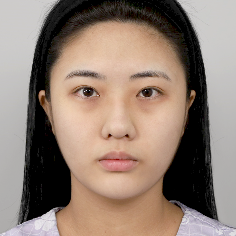 #Хамрын гол (силикон) #Хамрын үзүүр (өөрийн мөгөөрс) #Өөрийн хавирганы мөгөөрсөөр хийсэн хамар заслын мэс засал