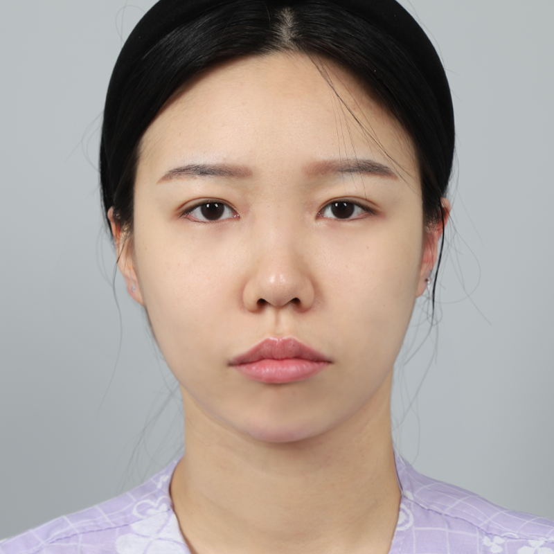 #Хамрын гол (силикон) #Хамрын үзүүр (өөрийн мөгөөрс) #Хэсэгчилсэн зүслэг #Дээд зовхины угалз #Ар доод зовхины угалз