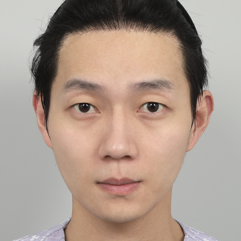 #Хэсэгчилсэн зүсэлт #Нүдний хэлбэр засах