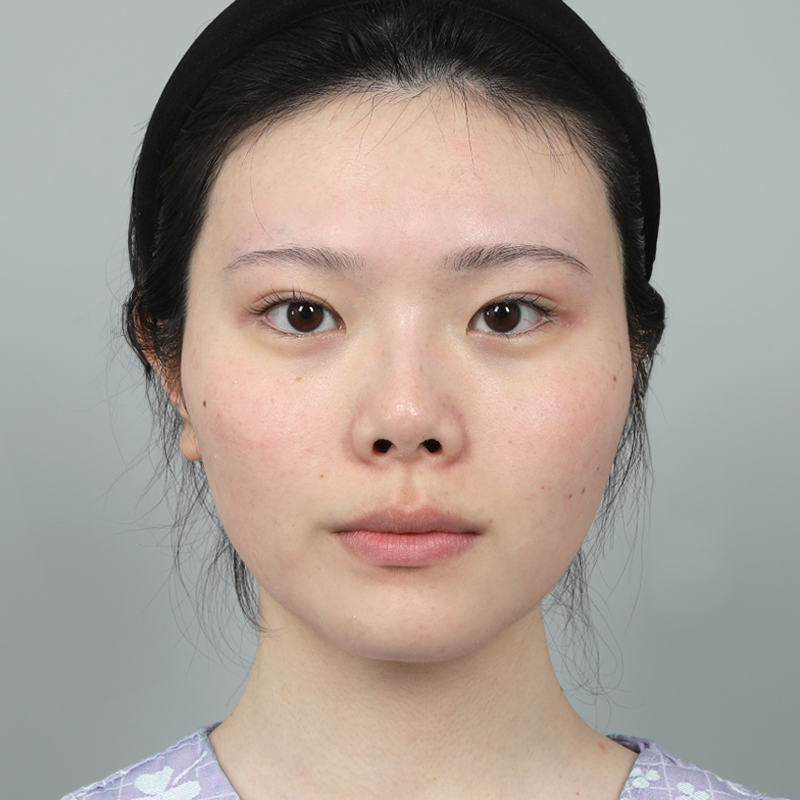 #Хамрын нуруу (силикон) #Хамрын үзүүр (өөрийн мөгөөрс) #Өөрийн хавирганы мөгөөрсөөр хийсэн хамрын хагалгаа #Богино хамар (хайрцаг хамар) засах