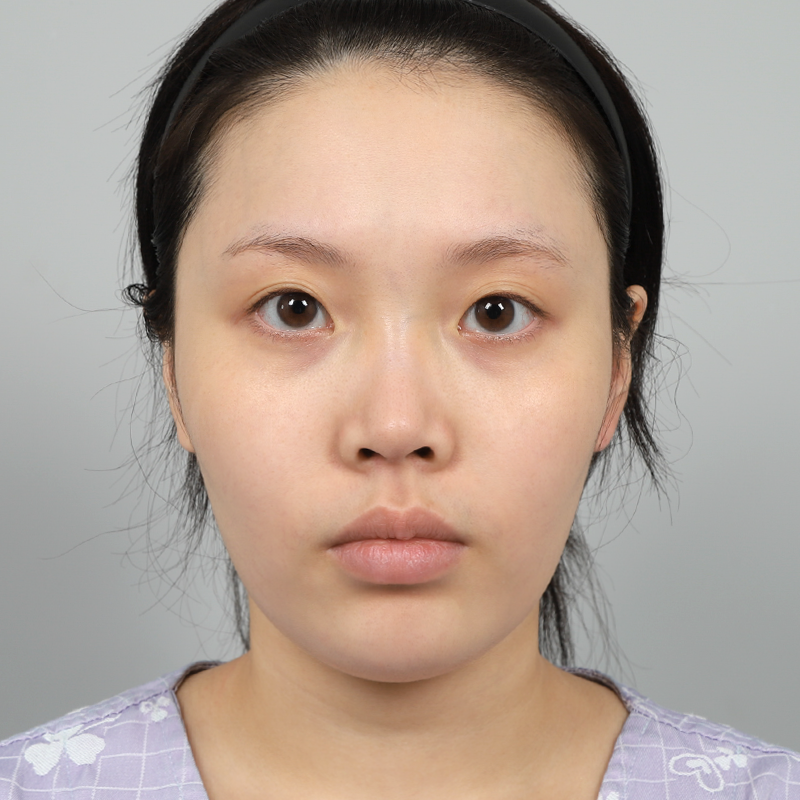 #Хэсэгчилсэн зүсэлт #Хамрын нуруу (силикон) #Хамрын үзүүр (өөрийн мөгөөрс)