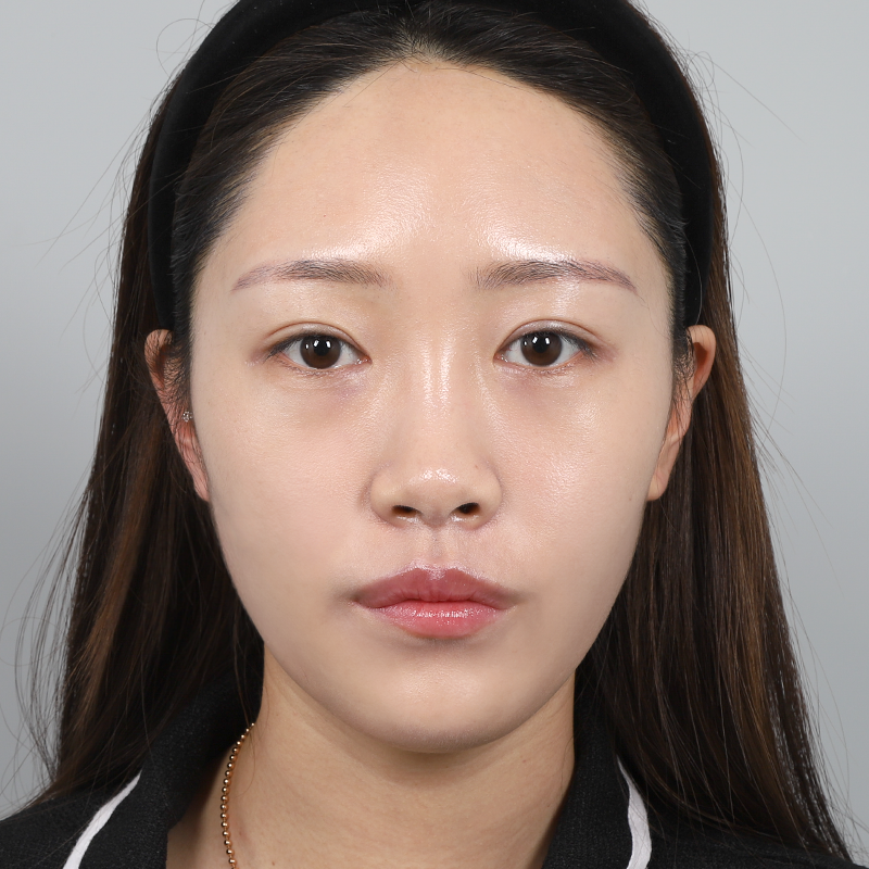 #Хамрын нуруу (силикон) #Хамрын үзүүр (өөрийн мөгөөрс) #Нүдний доорхи өөх тосыг дахин байршуулах бүх нүүрний өөх шилжүүлэн суулгах