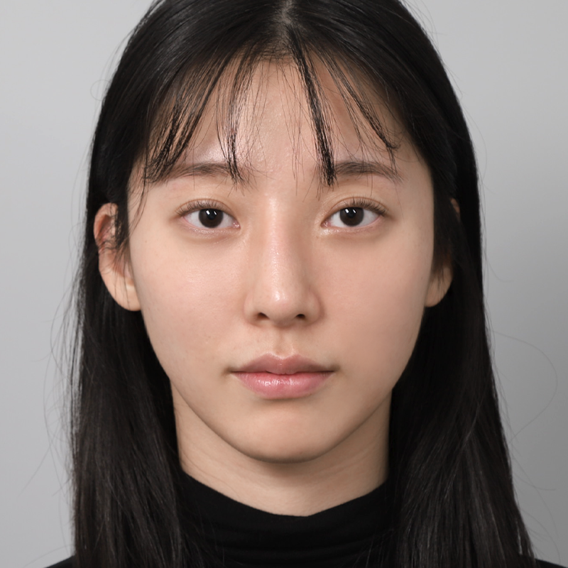 #Хамрын үзүүр (өөрийн мөгөөрс) #Хиймэл биетгүй хамрын мэс засал #Бөх hump засварлах #Хамрын дахин мэс засал